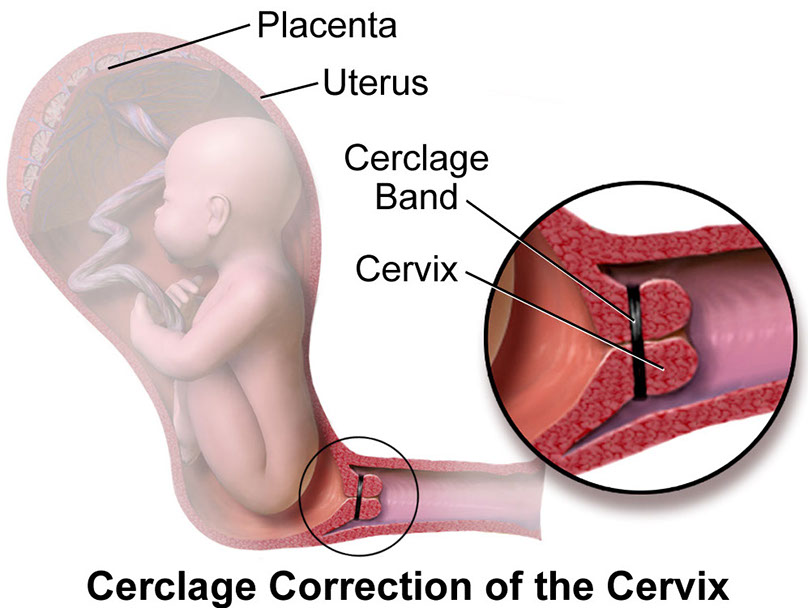 Preterm Birth